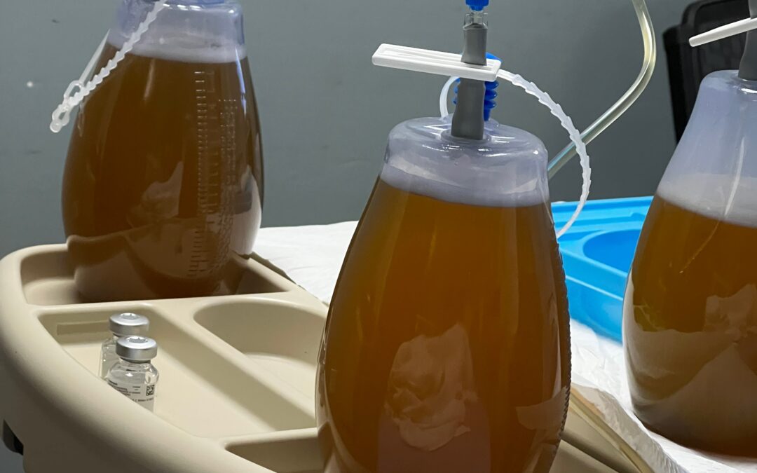 Paracentesis – A New Experience